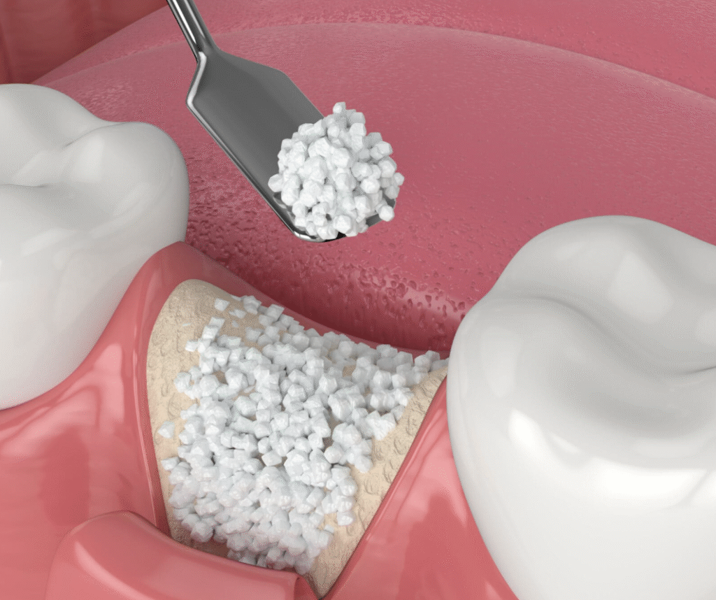 Bone grafting procedure at Grayson dental office